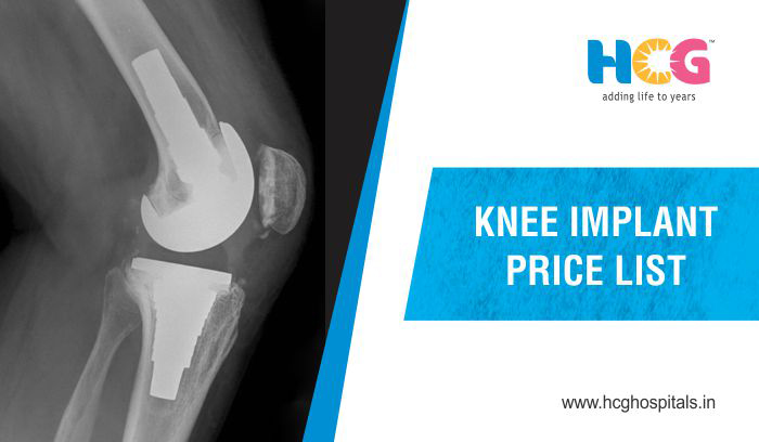 Knee Implant Price List