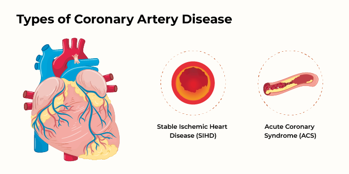 Coronary Artery Disease Types