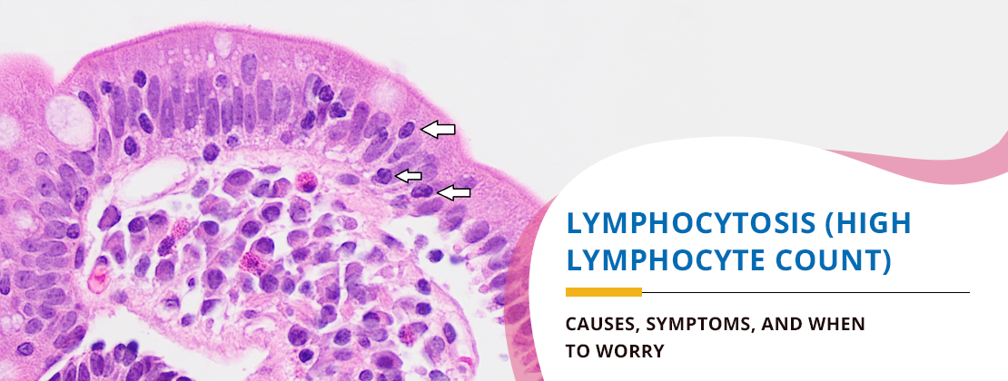 Lymphocytosis