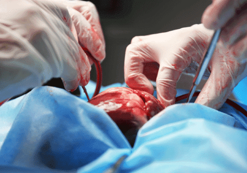 What to Expect During Heart Bypass Surgery at HCG Hospitals