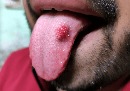 Oral Cancer: Types and Symptoms