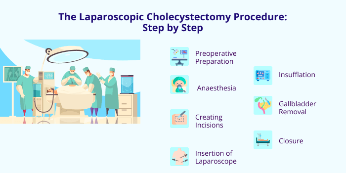 The Laparoscopic Cholecystectomy Procedure: Step by Step