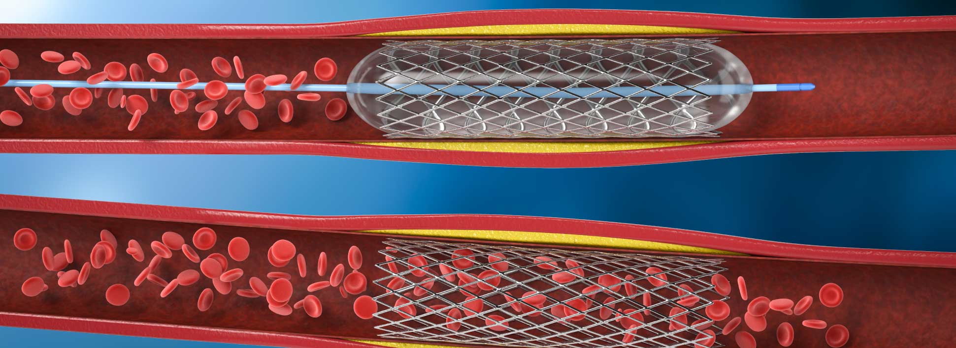 Angioplasty treatment in Ahmedabad